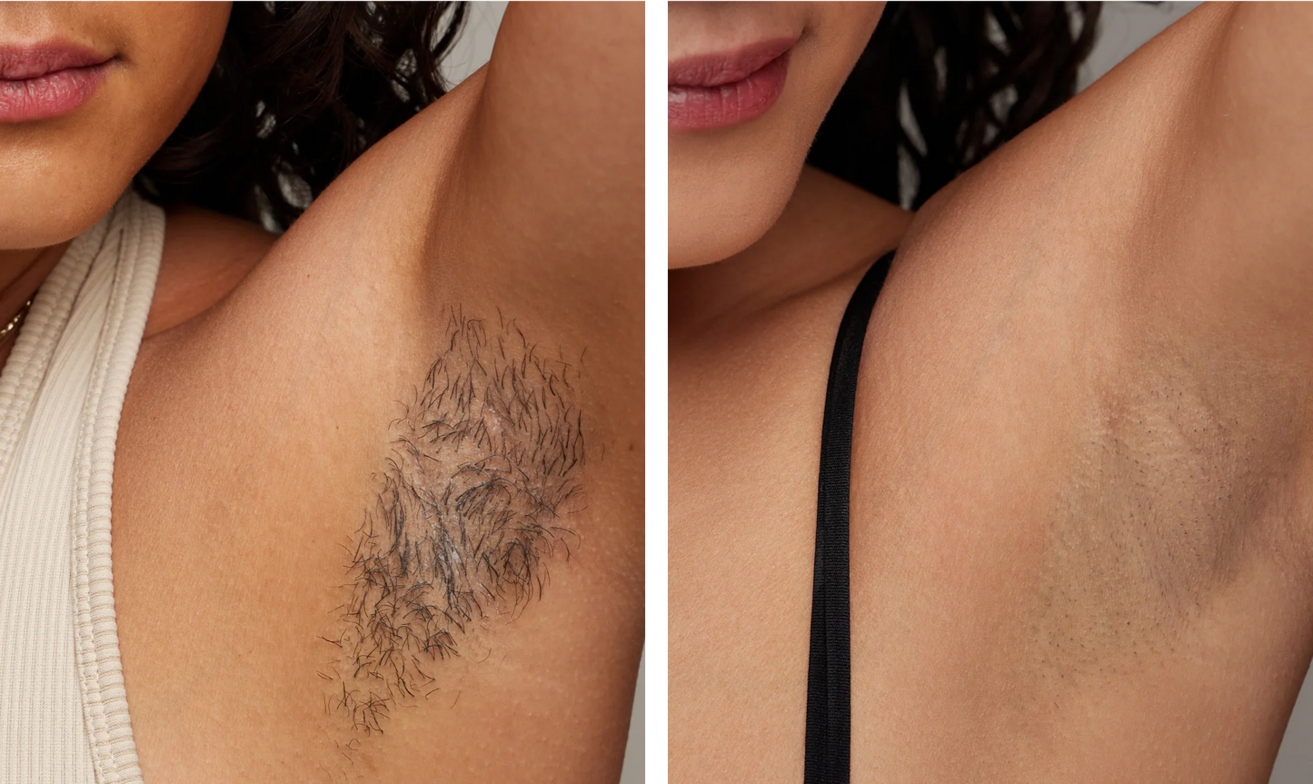 Yael Amari™ | Laser Air 10