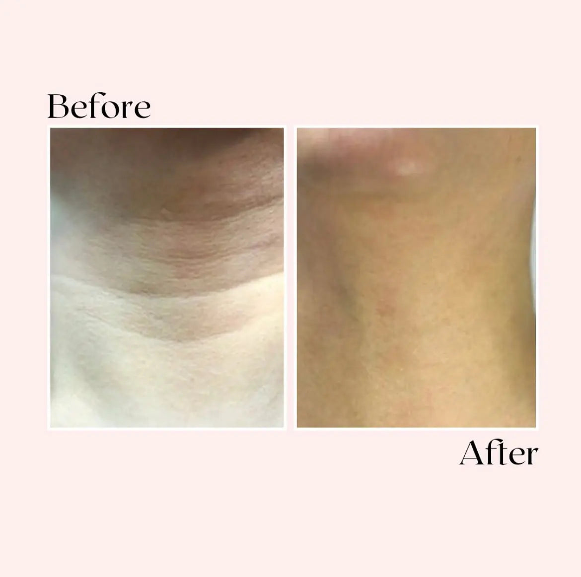Yael Amari™ Micro Infusion SERUM Kit